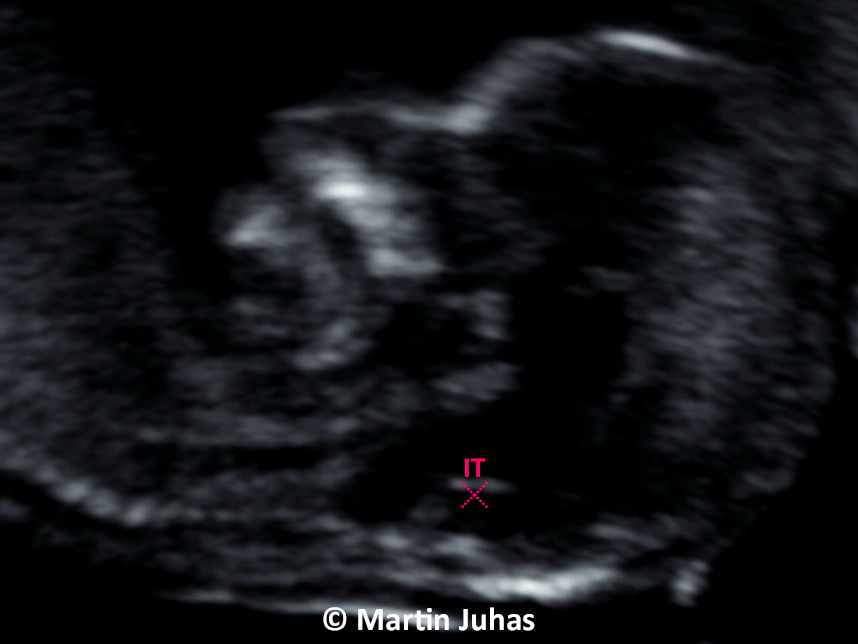 Foetuses with schistorrhachis in the 1st trimester