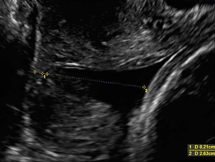 skrining pedcasneho porodu abnormalny nalez