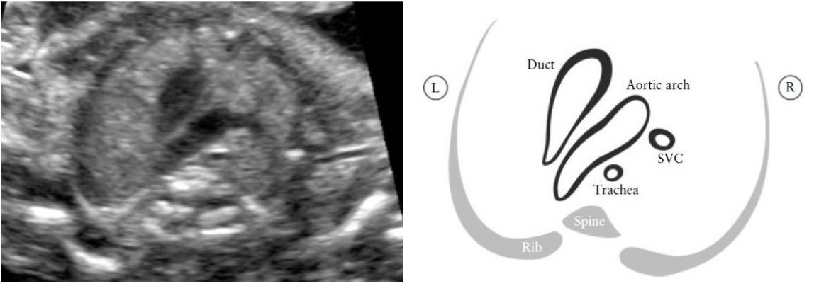 Аберрантная подключичная артерия. Срез 3 сосуда у плода на УЗИ. Срез через 3 сосуда у плода. Сердце срез через 3 сосуда.