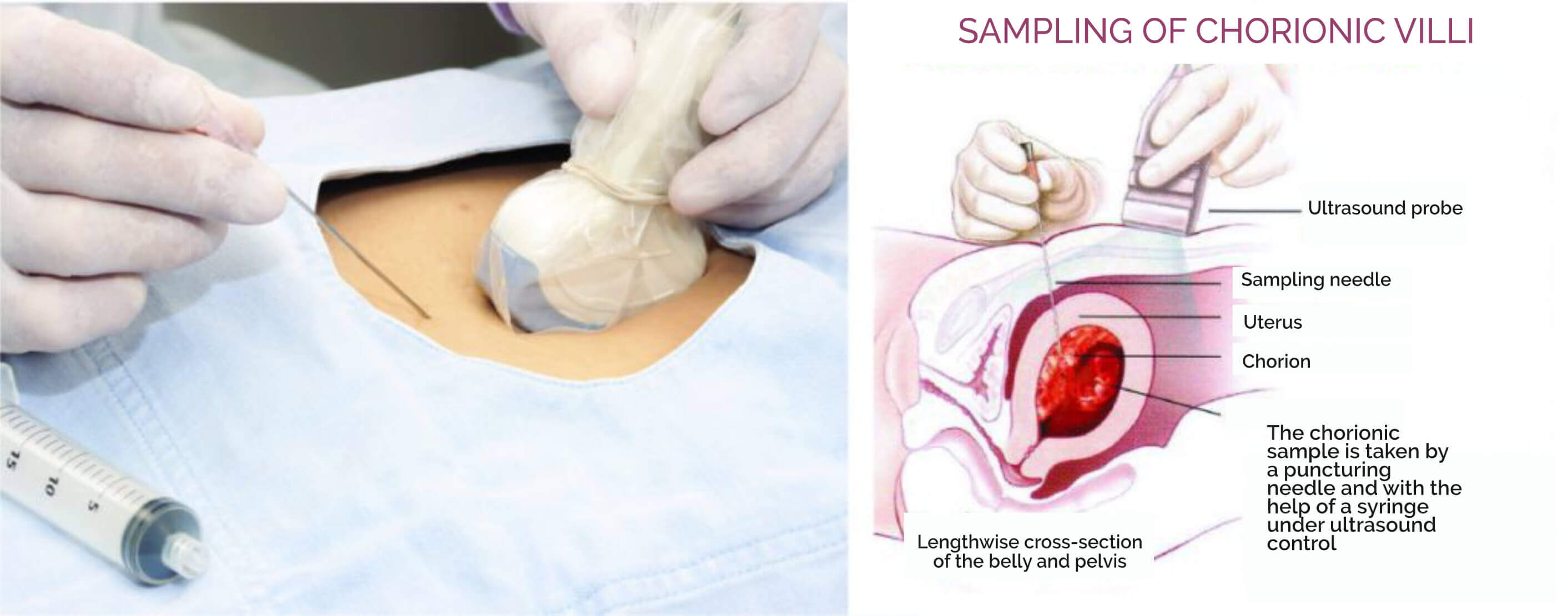 SAMPLING OF CHORIONIC VILLI