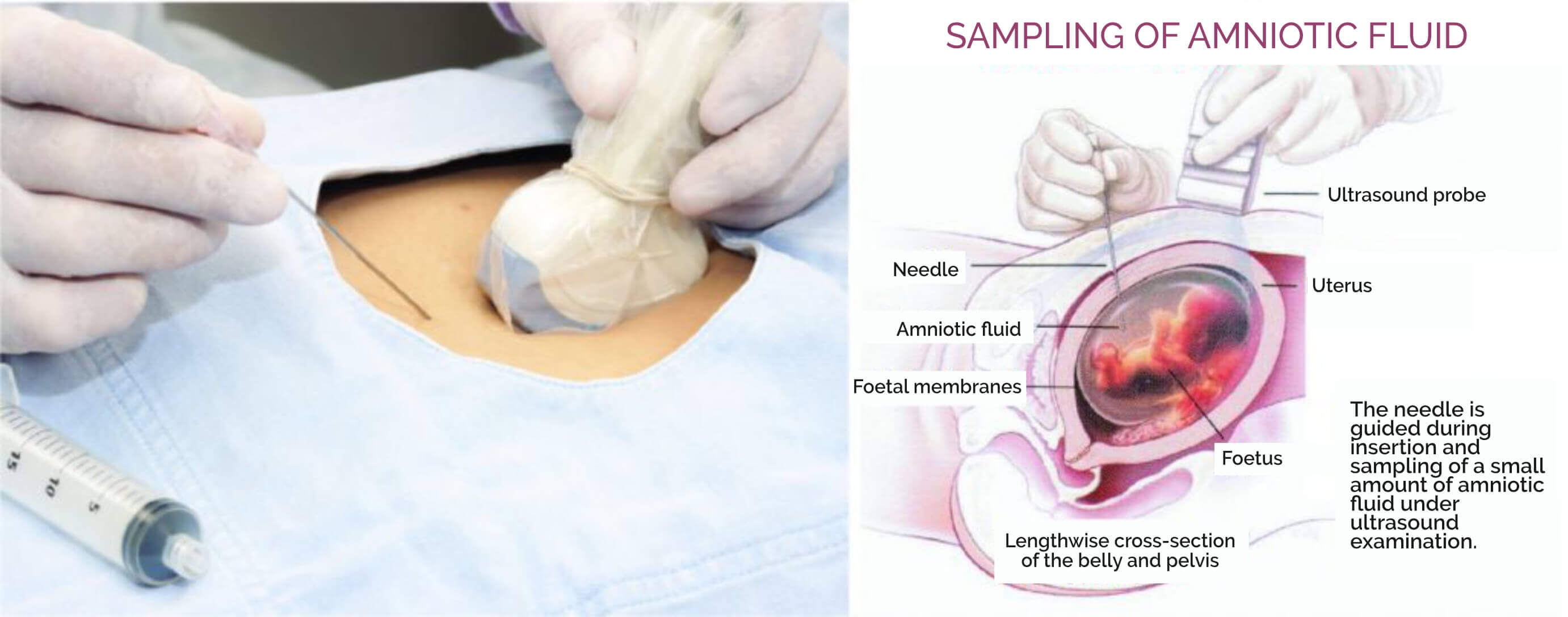 SAMPLING OF AMNIOTIC FLUID